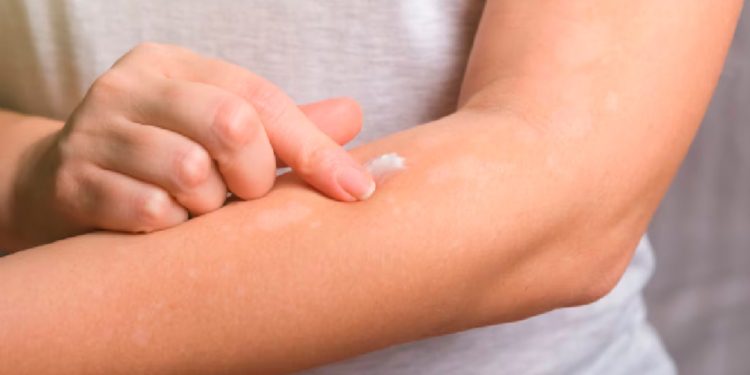 Psoriasis requiere diagnóstico y atención oportunos; está ligada a otros padecimientos