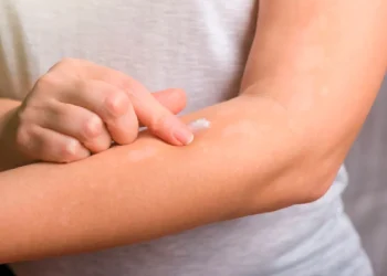 Psoriasis requiere diagnóstico y atención oportunos; está ligada a otros padecimientos